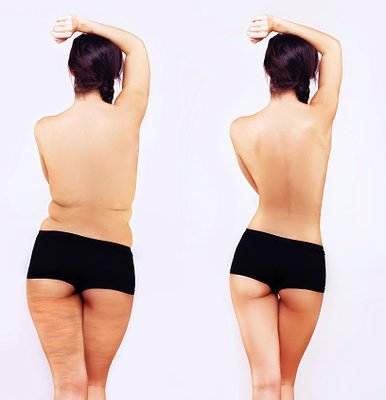 Body Sculpting at Chiltonic - The application of cold alone — as in cryoliposis — has been shown to break down fat cells which can contribute to the unsightly appearance of cellulite. Thermal shock goes a step further and eliminates the cells from the body through lymphatic drainage for more immediate and effective results. Using alternating cycles of hot and cold, thermal shock kills fat cells and reverses the signs of cellulite by increasing blood flow and circulation, stimulating the production of collagen, and improving overall skin elasticity.

By using extreme cold to constrict blood vessels, thermal shock treatments are able to break down fat cells without damaging other tissues.  By alternating cold with hot temperatures, the non-invasive therapy kills subcutaneous fat cells and then expels them from the body, gradually eliminating the signs of cellulite and promoting a smooth skin surface.

In a case study of 92 women, aged 31 to 62 years old, 69 women saw a complete reduction in cellulite of the legs via thermal shock treatment across eight sessions.  19 women saw moderate improvement and only little or no improvement.

To experience the difference, visit us!

If you have any of the following issues with FACE / NECK / DECOLLETE,  you should consider T-Shock Treatment.

• Aging and are more desirous of a natural look without the use (or reduced use) of Botox and Fillers

• Looking for a Red Carpet look for an event

•  Loose skin or wrinkles on the neck

• A double chin

• An aging neck or decollete

 

If you have any of the following issues and desire TONING, you should consider T-Shock Treatment.

• Dry, crepey, aging skin

• Loose, aging skin that has lost elasticity

•Undergone gastric bypass surgery; experienced rapid weight loss; experienced loose skin following pregnancy

 

If you have any of the following issues and desire FAT AND CELLULITE REDUCTION, you should consider T-Shock Treatment.

• A BMI under 35 who has excessive fat deposits in problem areas

• In shape with stubborn fat that they can’t get rid of with diet and exercise

• Desirous of controlling cellulite