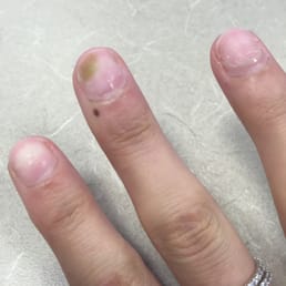 Fungus on nail Fungus on nail