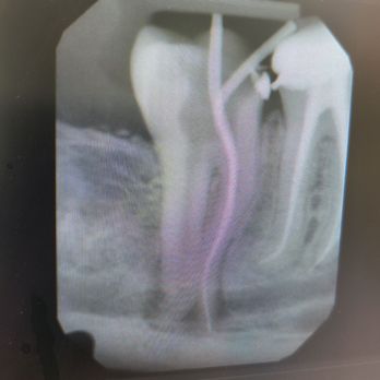 Calstate Dental - Working on a difficult Root canal - General Dentistry Near Me - Monterey Park, California Calstate Dental - Working on a difficult Root canal - General Dentistry Near Me - Monterey Park, California