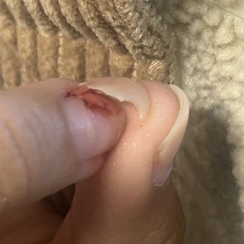 Queen Nails - My real nail bed coming off with the acrylic nail - Nail Technicians Near Me - Los Angeles, California