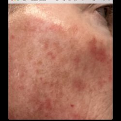 Spargo Salon and Spa - Right cheek after peel