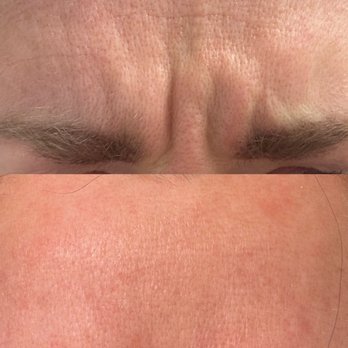 Primrose Medical - 30 days after Botox - Medical Spas Near Me - Reno, Nevada Primrose Medical - 30 days after Botox - Medical Spas Near Me - Reno, Nevada