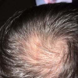 Bosley Hair Restoration & Transplant - Before Bosley Hair transplant,