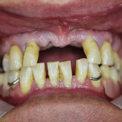 Dental Artistic - Before implants Overdenture case