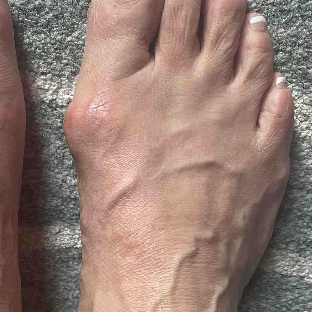 Precision Foot and Ankle Centers - Right foot before surgery. - Podiatrists Near Me - Torrance, California Precision Foot and Ankle Centers - Right foot before surgery. - Podiatrists Near Me - Torrance, California