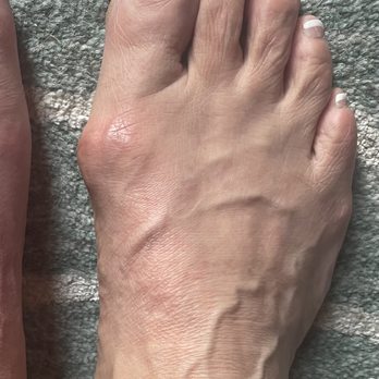 Precision Foot and Ankle Centers - Right foot before surgery. - Podiatrists Near Me - Torrance, California Precision Foot and Ankle Centers - Right foot before surgery. - Podiatrists Near Me - Torrance, California
