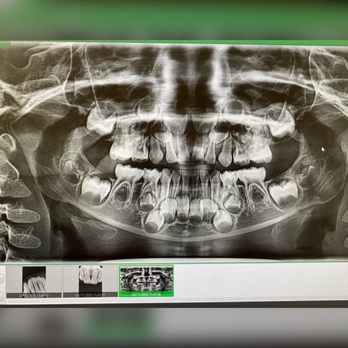 TruDental - I've never seen kid X-ray!! So crazy how many teeth are waiting to come out... very detailed X-ray - General Dentistry Near Me - Cypress, California