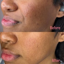 BlossomMD Medical Spa & Wellness - Skinpen 3 session