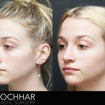 Amit Kochhar, MD - Before and After Rhinoplasty - Plastic Surgeons Near Me - Los Angeles, California Amit Kochhar, MD - Before and After Rhinoplasty - Plastic Surgeons Near Me - Los Angeles, California