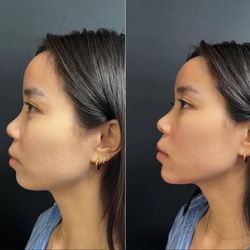 Skin MD - Our Chin Filler treatments are designed to enhance your profile, improve facial symmetry, & create a more defined jawline, without surgery.