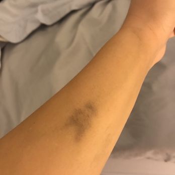 Bluterguss nach blutabnahme