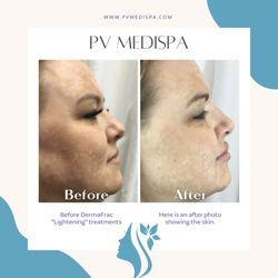 DermaFrac (microneedling) using "lightener"