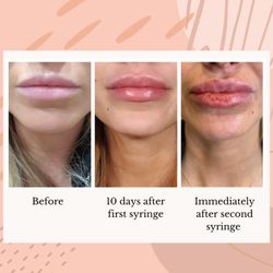 Full & flauntable lips achieved using 2 syringes of Juvederm Ultra Plus over multiple visits done by our RN Sally!