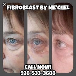 Salon Me'chel - Phone number to call and an example of Fibroblast