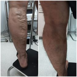 Varicose Vein Laser Center & Med Spa - Results of satisfied patient
Before & After