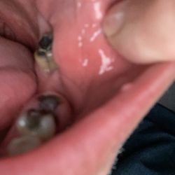 Pacific Dental Care - Poor dental work rendered by Pacific Dental located at @1429 College Avenue in Modesto, Ca.