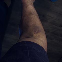 Pathology Laboratory - Bruise
