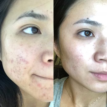 Fresh Faces - November 2017 - June 2018 - Skin Care Near Me - Costa Mesa, California Fresh Faces - November 2017 - June 2018 - Skin Care Near Me - Costa Mesa, California