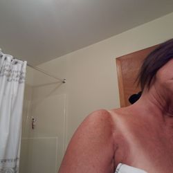 Premier Orthopaedics - See how tiny my shoulder looks? That's the result of Dr. Bavaro deciding that he didn't have to put my muscle back