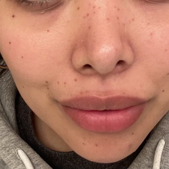 Jenny Inks - Tattoo freckles day 2 of healing. - Permanent Makeup Near Me - Las Vegas, Nevada