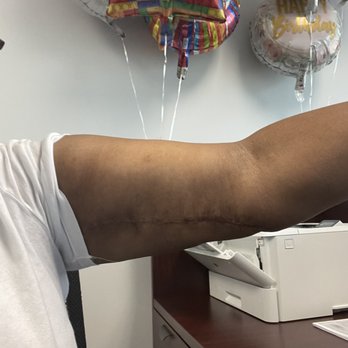 Emil Kohan, MD - After. I'm still swollen but Dr K changed my life. He fixed a botched procedure. - Plastic Surgeons Near Me - Beverly Hills, California