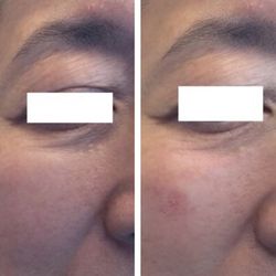Metamorphosis Holistic MedSpa - Female Under Eye (1cc of Belotero) Filler