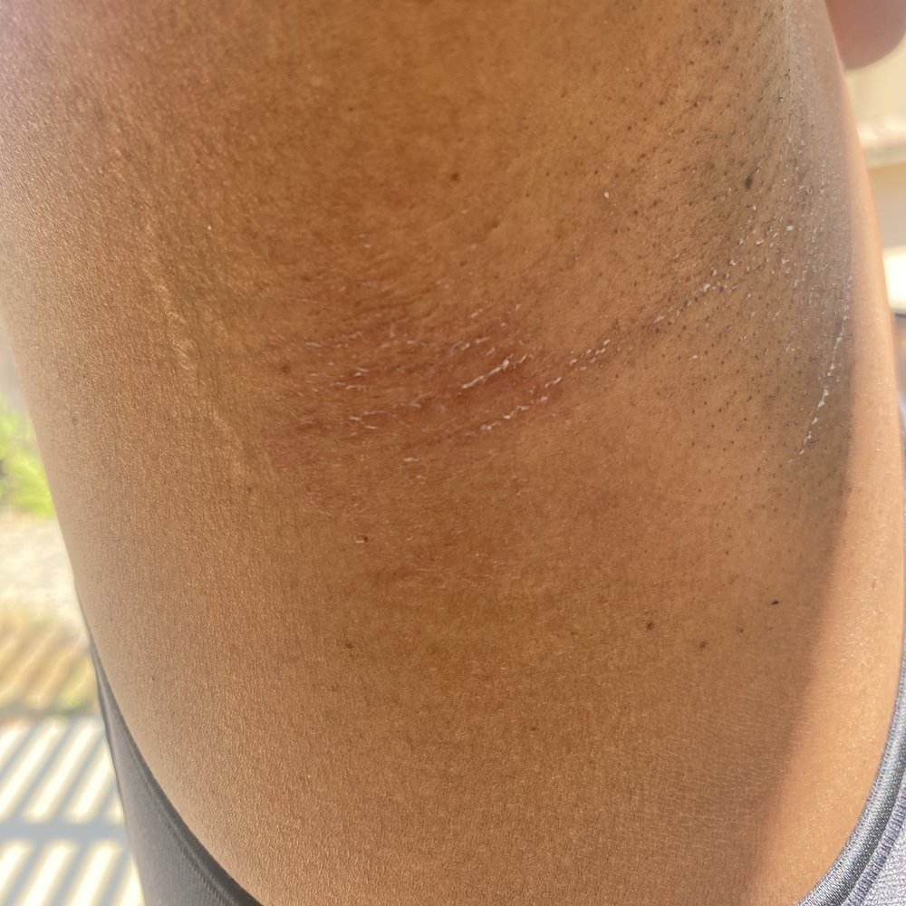 LaserAway - Right sided burns - Medical Spas Near Me - Rancho Cucamonga, California LaserAway - Right sided burns - Medical Spas Near Me - Rancho Cucamonga, California