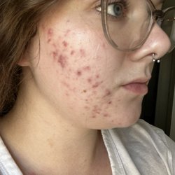 Lux Dermatology- Hanford - Before starting acne treatment