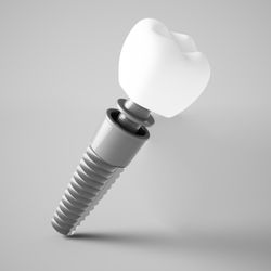 Dental Implants act like a tooth root and help to preserve bone.