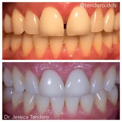 10 Dental Design Studio - Invisalign + Whitening