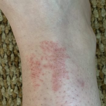 La Venice Nails & Spa - I got the la Venice spa pedicure and was left with this , I have sensitive skin and don't advise getting this If you do. - Nail Salons Near Me - Geneva, Illinois
