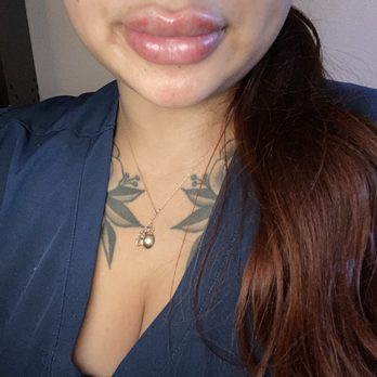 NakedMD - After - Medical Spas Near Me - Downey, California