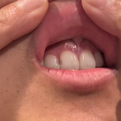 StoneCreek Dental - Vestavia Hills - Previous fillings by Dr Headley