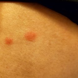Holiday Inn Express & Suites Fraser - Winter Park Area - Insect bites I noticed when I woke up.