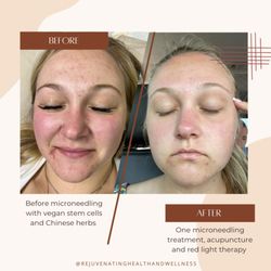 Rejuvenating Health and Wellness - Microneedling with customized vegan stem cells for acne.