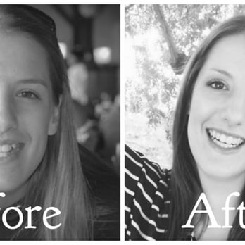 Prime Dental Care: Peter Bishay, DMD - My smile before and after. Thank you Dr. Bishay for the amazing work! - General Dentistry Near Me - Orange, California