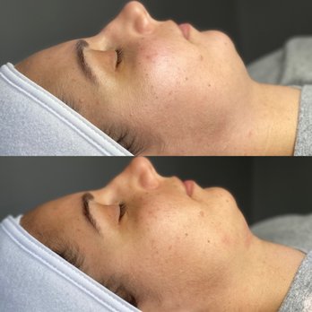 Sugar&Skin Aesthetics - O2 Mirco Lift (Below-Before) (After-Top) - Sugaring Near Me - Fairlawn, Ohio Sugar&Skin Aesthetics - O2 Mirco Lift (Below-Before) (After-Top) - Sugaring Near Me - Fairlawn, Ohio