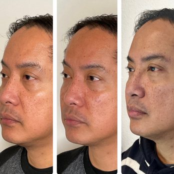 J'Clinic - Undereye and cheek rejuvenation - Medical Spas Near Me - Walnut Creek, California J'Clinic - Undereye and cheek rejuvenation - Medical Spas Near Me - Walnut Creek, California