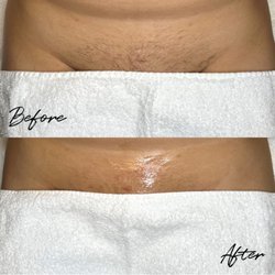 Salem Beauty - Before + After Brazilian Sugaring