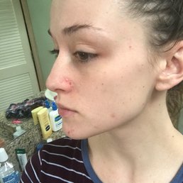 5 days after the facial.. seriously??