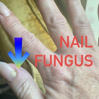 Nails Trix and Spa - Yes that's Nail fungus it's dangerous and hurts! - Nail Salons Near Me - Oak Ridge, Tennessee