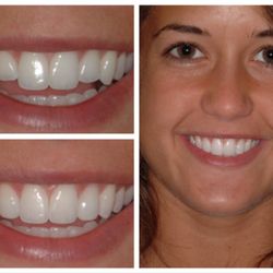 Cosmetic Bonding