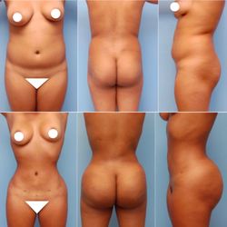 Before and After: Brazilian Butt Lift and Body Contouring