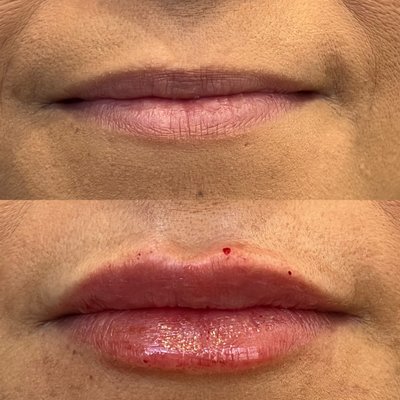 Lip Filler - Welcome to our Lip Filler Portfolio, where we showcase the skillful artistry and transformative results of our lip enhancement procedures. At Restore Wellness, we believe that achieving the perfect pout is not just about volume; it's about balance, symmetry, and enhancing your unique beauty. Lip Filler - Welcome to our Lip Filler Portfolio, where we showcase the skillful artistry and transformative results of our lip enhancement procedures. At Restore Wellness, we believe that achieving the perfect pout is not just about volume; it's about balance, symmetry, and enhancing your unique beauty.