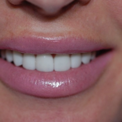 First Choice Dental - After First Choice Dental veneers
