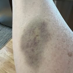 Quest Diagnostics - Bruise