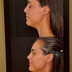 Goodjuju Aesthetics - Before and Afters 2 week follow up Botox, cheek and jawline filler