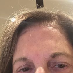 Associated Plastic Surgeons - Today's picture - scar visible and lumps on my forehead. I 1/2 years and it is forever a scar on my forehead.