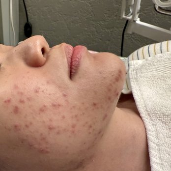 Acne Solutions Skin Care & Spa - Acne Treatment Near Me - Upland, California Acne Solutions Skin Care & Spa - Acne Treatment Near Me - Upland, California