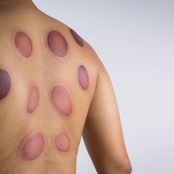 John Fine Massage - Cupping - Massage Therapy Near Me - Raleigh, North Carolina John Fine Massage - Cupping - Massage Therapy Near Me - Raleigh, North Carolina